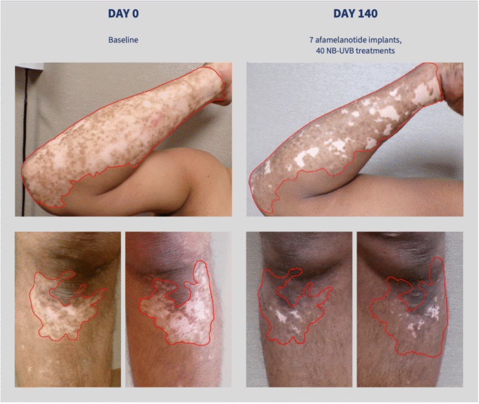 CLINUVEL recruits 200 patients in Phase III vitiligo trial CUV105