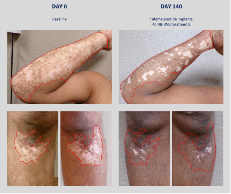 CLINUVEL recruits 200 patients in  Phase III vitiligo trial CUV105